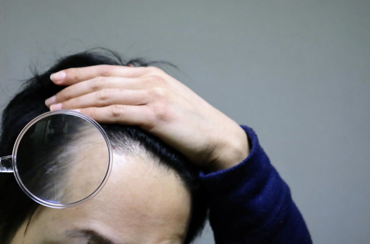 AGAの遺伝メカニズム（母方X染色体・両親常染色体）のイメージ